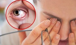 Chăm sóc người bị xuất huyết dưới kết mạc tại nhà