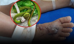 Em bé 7 tháng tuổi bất ngờ bị rắn cắn khi đang chơi, chân sưng tím
