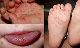 Trẻ đã từng mắc tay chân miệng vẫn có thể mắc lại