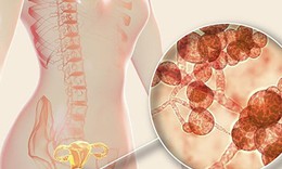 Mẹ bầu mắc nấm âm đạo nên uống thuốc hay đặt thuốc?