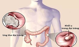 Ung thư đại trực tràng thường di căn đến đâu?