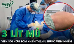Viên sỏi hơn 1cm suýt phá hỏng quả thận người đàn ông