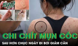 Cô gái mọc mụn cóc khắp người sau hơn chục ngày đi bơi giảm cân 