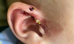 Lưỡi câu móc vào vành tai bé 10 tháng tuổi