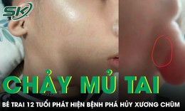 Bé 12 tuổi chảy mủ tai hôi, phát hiện bệnh phá hủy xương chũm
