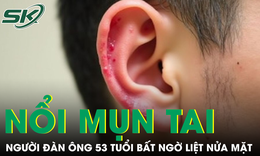 Nổi mụn nước ở tai, người đàn ông 53 tuổi bất ngờ liệt nửa mặt