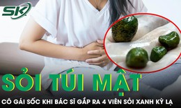 Cô gái 'sốc' khi bác sĩ gắp 4 viên sỏi xanh kỳ lạ trong túi mật