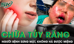 Sau điều trị tủy răng, người bệnh đái tháo đường sưng mặt, không há được miệng
