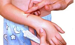 Lưu &#253; khi d&#249;ng bạc sulfadiazin trị vết thương, vết bỏng
