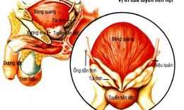 Bệnh tuyến tiền liệt – chớ coi thường!