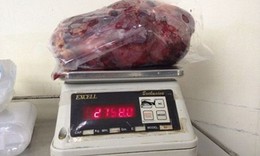 Cắt bỏ quả thận nặng gần 3 kg