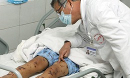 Tại sao nhiễm liên cầu lợn rất nguy hiểm