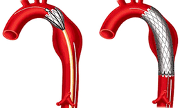 Đặt stent c&#243; nguy biến g&#236;?