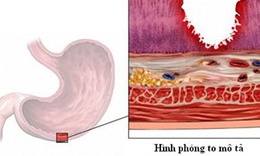 Dấu hiệu lo&#233;t đường ti&#234;u h&#243;a