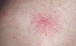 Biểu hiện ngoài da ở người bệnh gan