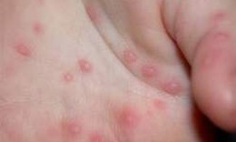 L&#242;ng b&#224;n tay nổi mụn v&#224; ngứa - Chữa trị thế n&#224;o?