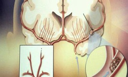 Tr&#224; thuốc cho người tăng huyết &#225;p