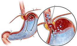 Thuốc điều trị bệnh tr&#224;o ngược dạ d&#224;y - thực quản