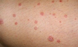 Mối nguy hiểm m&#224; bệnh lậu g&#226;y n&#234;n