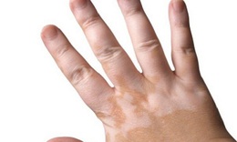 Bạch biến, trị c&#243; kh&#243;?