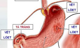 B&#224;i thuốc trị vi&#234;m lo&#233;t dạ d&#224;y - t&#225; tr&#224;ng