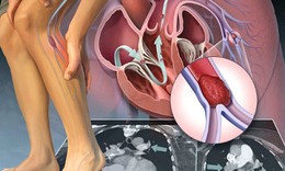Phát hiện sớm tắc động mạch chi dưới, tránh tàn phế