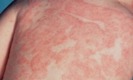 Thế n&#224;o l&#224; phản ứng dị ứng v&#224; c&#225;c bệnh dị ứng thường gặp