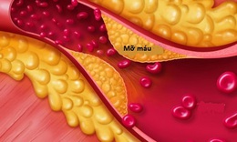 Lợi v&#224; hại của statin chữa rối loạn mỡ m&#225;u