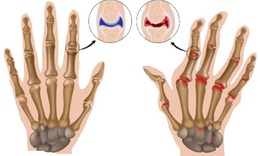 Lupus ban đỏ c&#243; g&#226;y đau khớp?