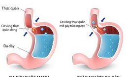 Trị đau tức ngực do tr&#224;o ngược dạ d&#224;y - thực quản, thuốc g&#236;?