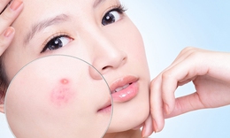 Hạn chế mụn trứng cá khi mang thai