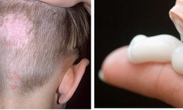 Lưu ý đặc biệt khi dùng thuốc cho trẻ bị nấm da đầu