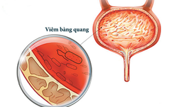 Tiểu nhiều, khi n&#224;o l&#224; bệnh l&#253;?