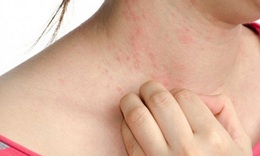 Dị ứng thời tiết chữa trị thế n&#224;o?