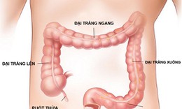 Người bệnh viêm đại tràng mạn tính tránh ăn gì?