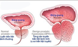 C&#225;c bệnh thường gặp ở tuyến tiền liệt