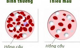 Thiếu m&#225;u do thiếu sắt, những điều cần biết