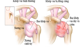 &#208;ề ph&#242;ng vi&#234;m quanh khớp vai