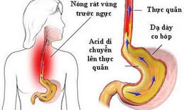 Tr&#224;o ngược dạ d&#224;y - thực quản g&#226;y ho nhiều, v&#236; sao?