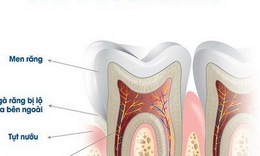 Răng &#234; buốt, nhạy cảm g&#226;y nhiều kh&#243; chịu