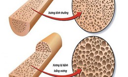 Thiếu canxi, trẻ c&#243; bị co giật?