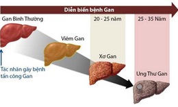 Rượu, bia g&#226;y xơ gan, ung thư gan thế n&#224;o?