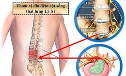 Xoa b&#243;p chữa đau lưng