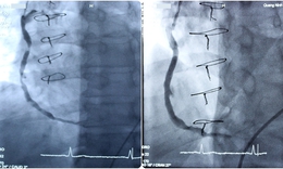 Quảng Ninh lần đầu ti&#234;n thực hiện th&#224;nh c&#244;ng  can thiệp đặt stent cầu nối tĩnh mạch hiển