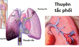 Cụ b&#224; được cứu sống ngoạn mục bằng ti&#234;u sợi huyết do thuy&#234;n tắc phổi