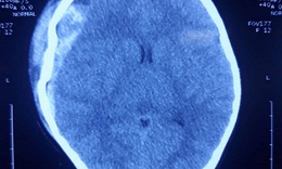 Cứu sống bé gái 6 tuổi bị chấn thương sọ não nặng do ngã cầu thang