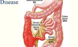 Thuốc l&#225; v&#224; nguy cơ mắc bệnh Crohn