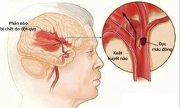 Liệu ph&#225;p statin ph&#242;ng ngừa đột quỵ- Lợi &#237;ch vẫn lớn hơn nguy cơ