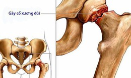 Giảm nguy cơ g&#227;y xương nhờ d&#249;ng thuốc chống lo&#227;ng xương sớm