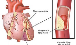 Lợi thế của thuốc acetaminophen đối với bệnh nh&#226;n nhồi m&#225;u cơ tim ST ch&#234;nh l&#234;n